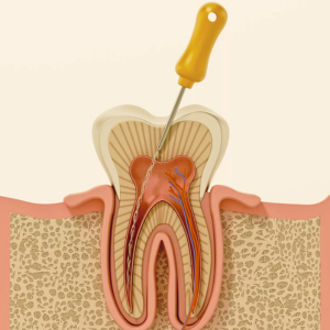 Root Canal Treatment