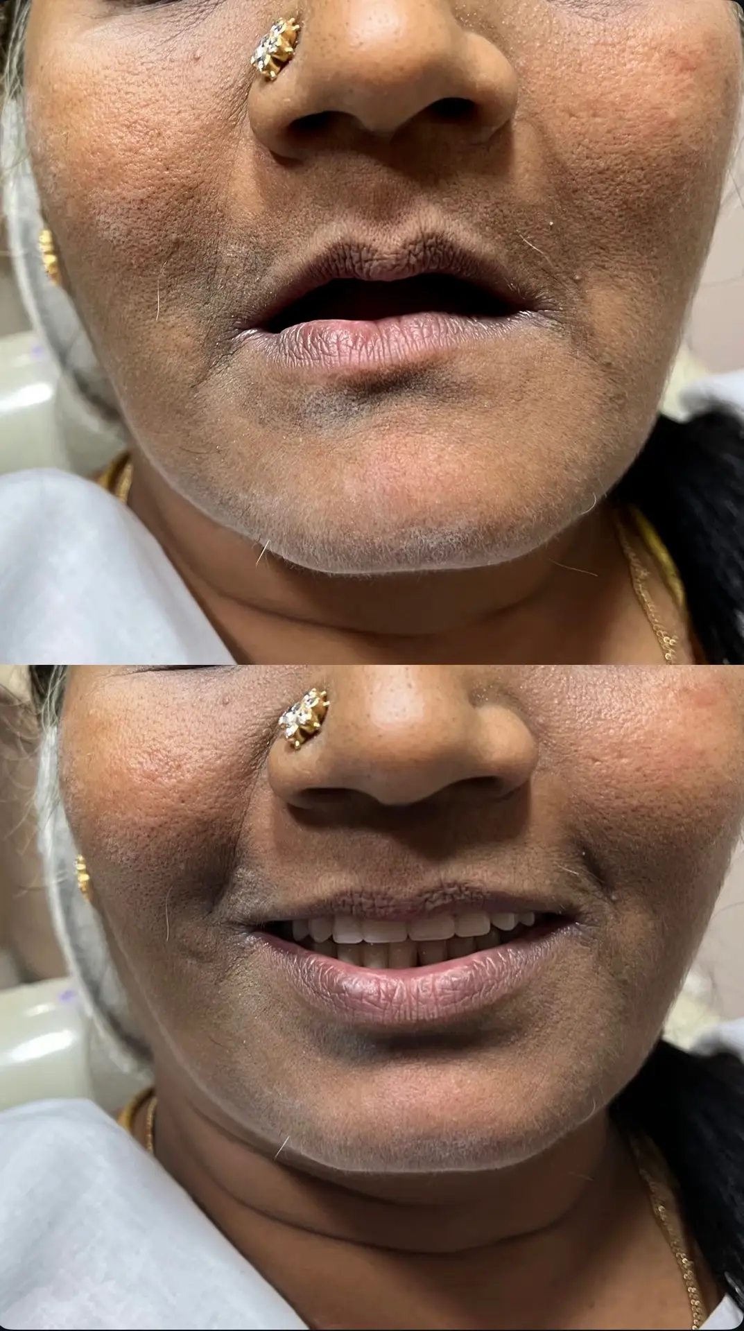 Full mouth rehabilitation