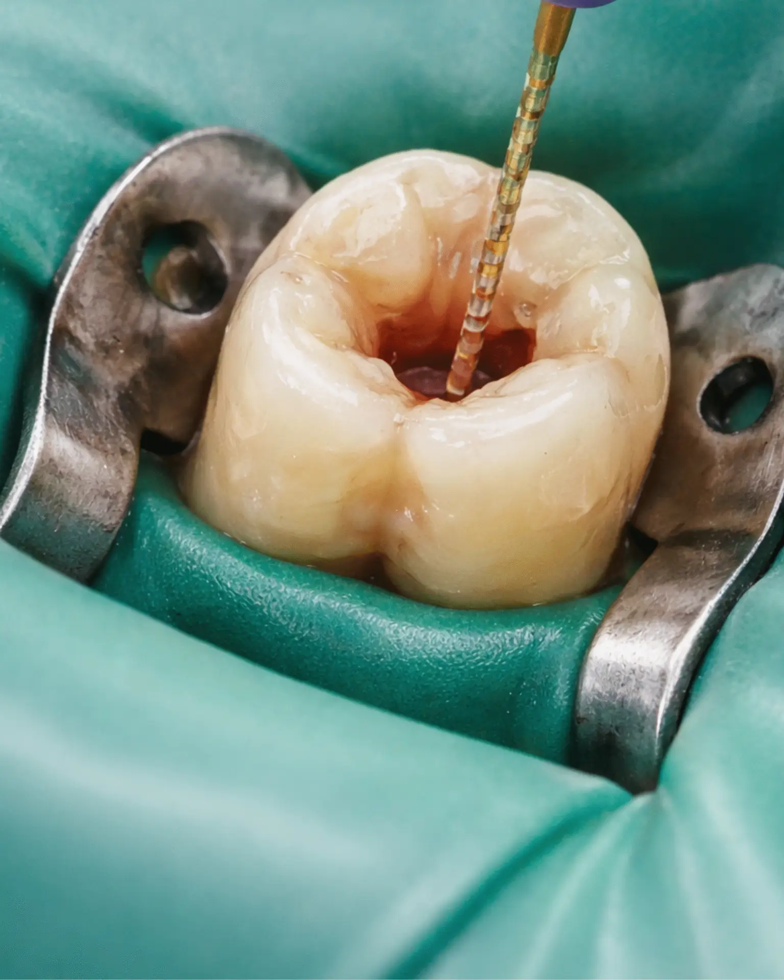 Root Canal Treatment